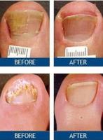 Laser Nail Therapy Clinic Montreal 2 image 3